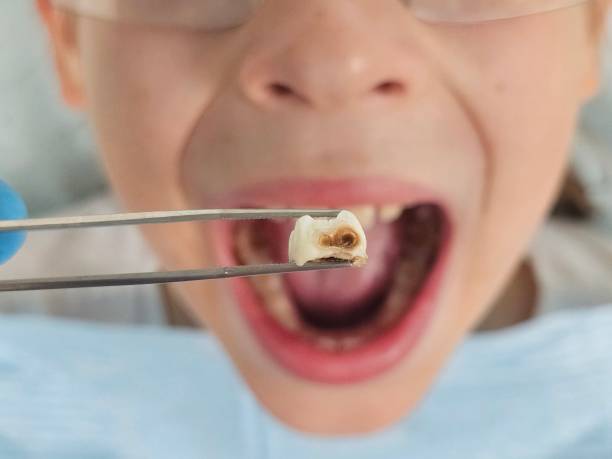 Best Emergency Tooth Extraction in Plains, KS